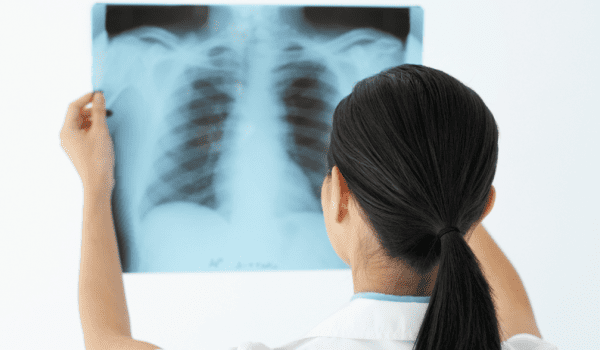 A person in a white lab coat is examining an X-ray film of a human chest.